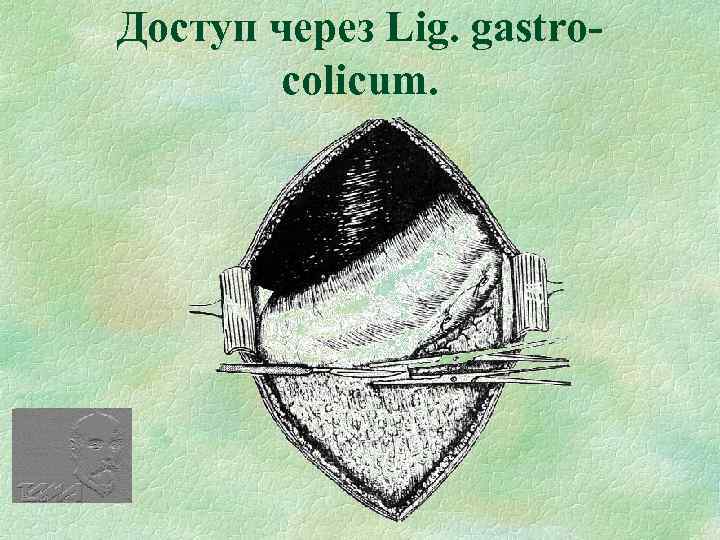 Доступ через Lig. gastrocolicum. 