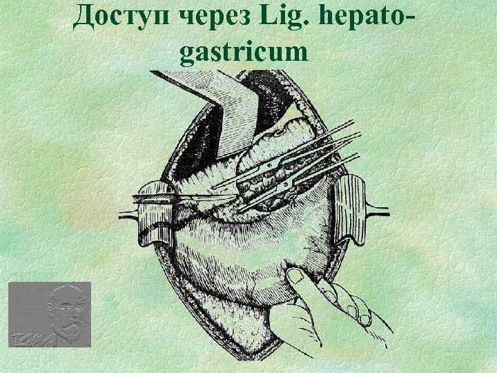 Доступ через Lig. hepatogastricum 