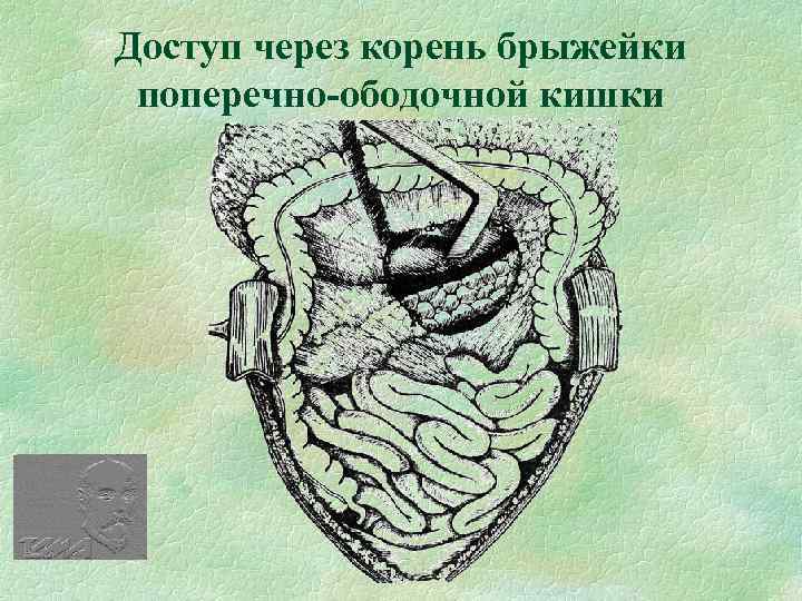 Доступ через корень брыжейки поперечно-ободочной кишки 