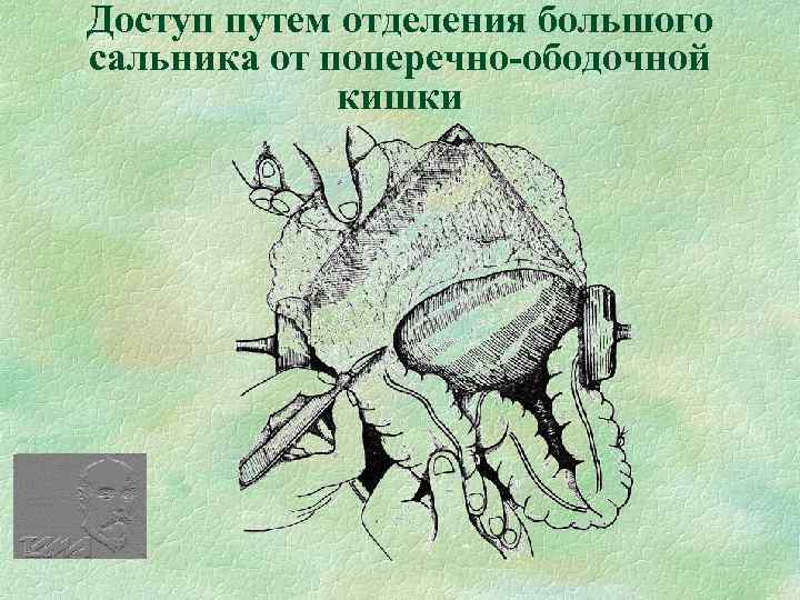 Доступ путем отделения большого сальника от поперечно-ободочной кишки 