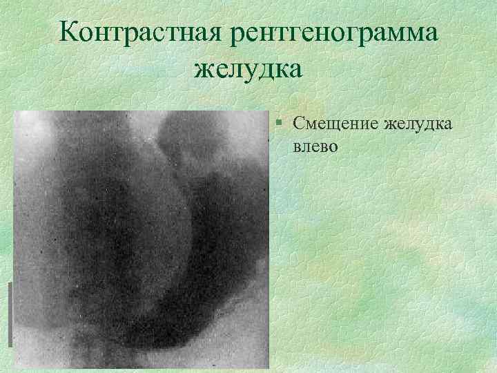Контрастная рентгенограмма желудка § Смещение желудка влево 