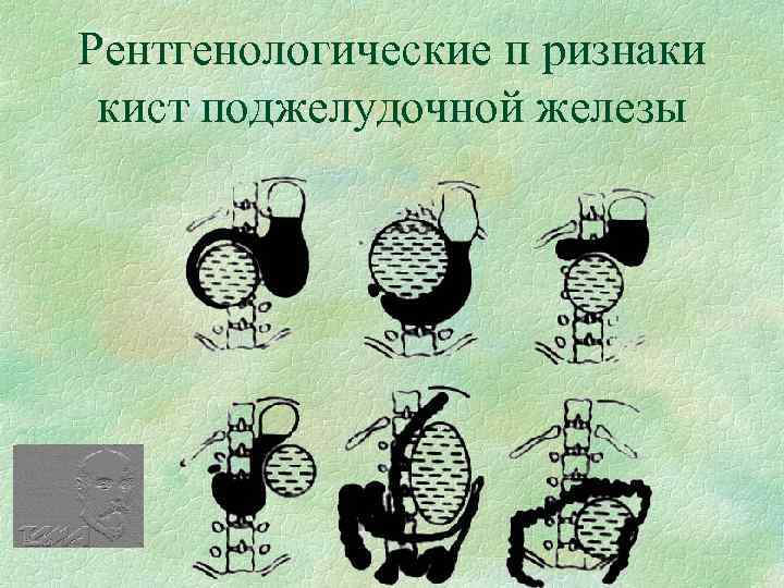 Рентгенологические п ризнаки кист поджелудочной железы 
