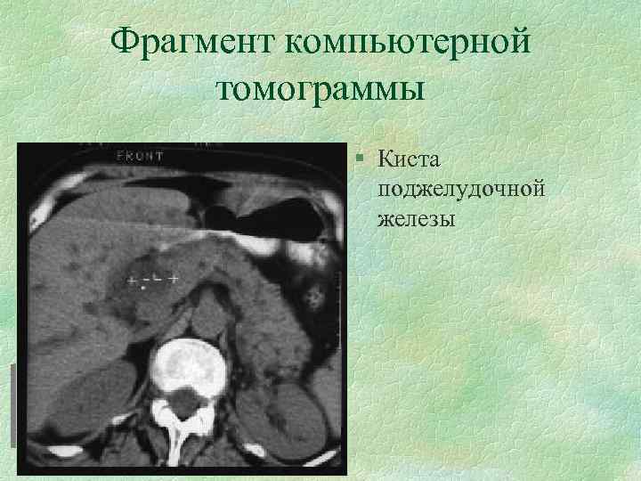 Фрагмент компьютерной томограммы § Киста поджелудочной железы 