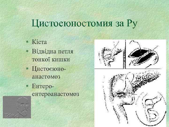 Цистоеюностомия за Ру § Кiста § Вiдвiдна петля тонкої кишки § Цистоєюноанастомоз § Ентероентероанастомоз