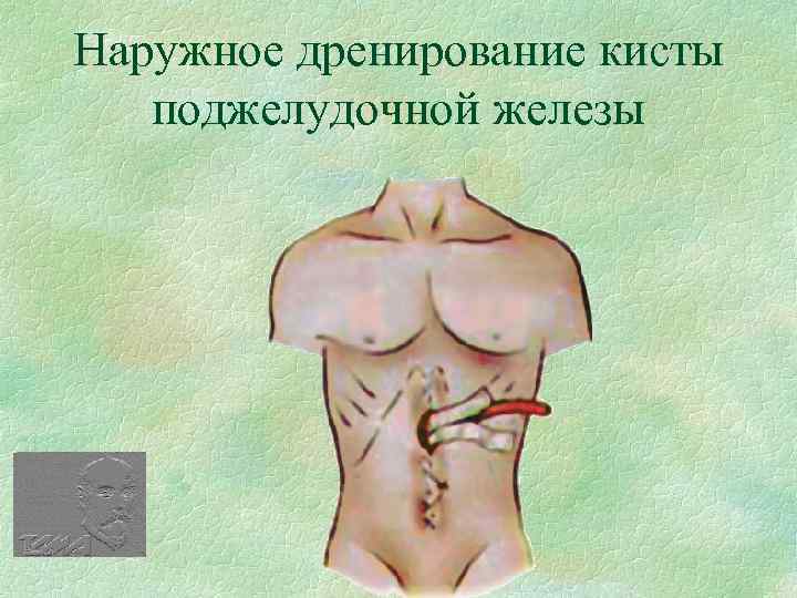Наружное дренирование кисты поджелудочной железы 