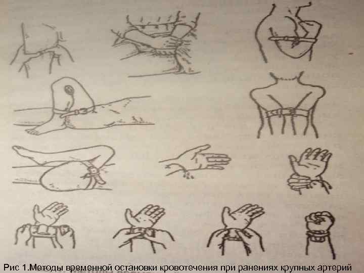 Рис 1. Методы временной остановки кровотечения при ранениях крупных артерий 