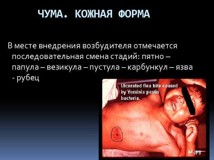 ЧУМА. КОЖНАЯ ФОРМА В месте внедрения возбудителя отмечается последовательная смена стадий: пятно – папула
