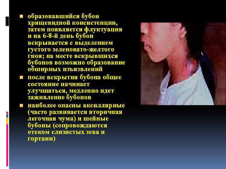 образовавшийся бубон хрящевидной консистенции, затем появляется флуктуация и на 6 -8 -й день бубон