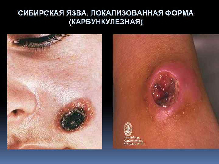 СИБИРСКАЯ ЯЗВА. ЛОКАЛИЗОВАННАЯ ФОРМА (КАРБУНКУЛЕЗНАЯ) 