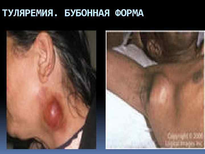 ТУЛЯРЕМИЯ. БУБОННАЯ ФОРМА 