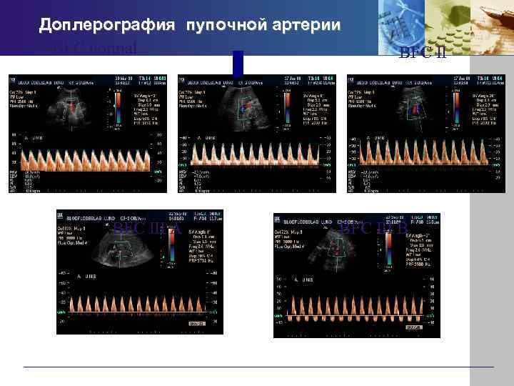 Доплерография пупочной артерии BFC normal BFC III A BFC III B 