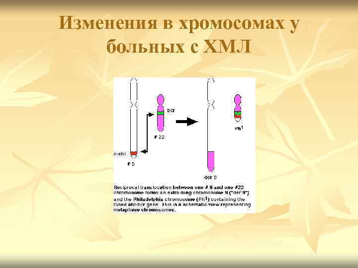 Изменения в хромосомах у больных с ХМЛ 