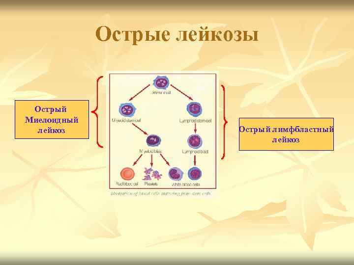 Острые лейкозы Острый Миелоидный лейкоз Острый лимфбластный лейкоз 