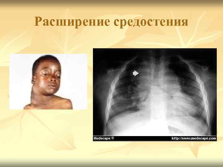 Расширение средостения 