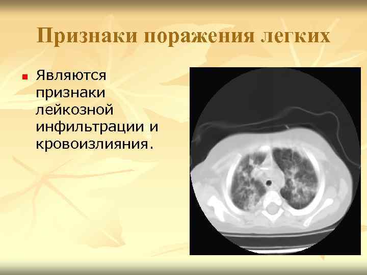 Признаки поражения легких n Являются признаки лейкозной инфильтрации и кровоизлияния. 