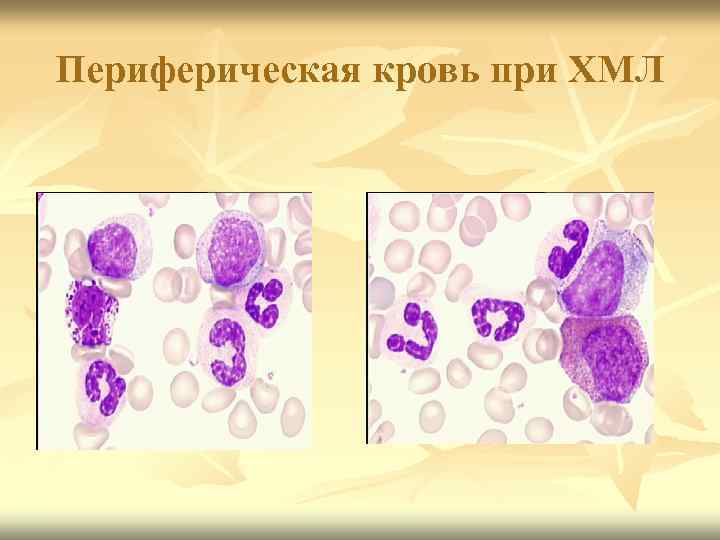 Периферическая кровь при ХМЛ 