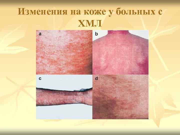 Изменения на коже у больных с ХМЛ 