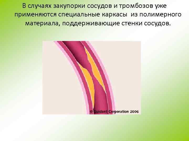 В случаях закупорки сосудов и тромбозов уже применяются специальные каркасы из полимерного материала, поддерживающие