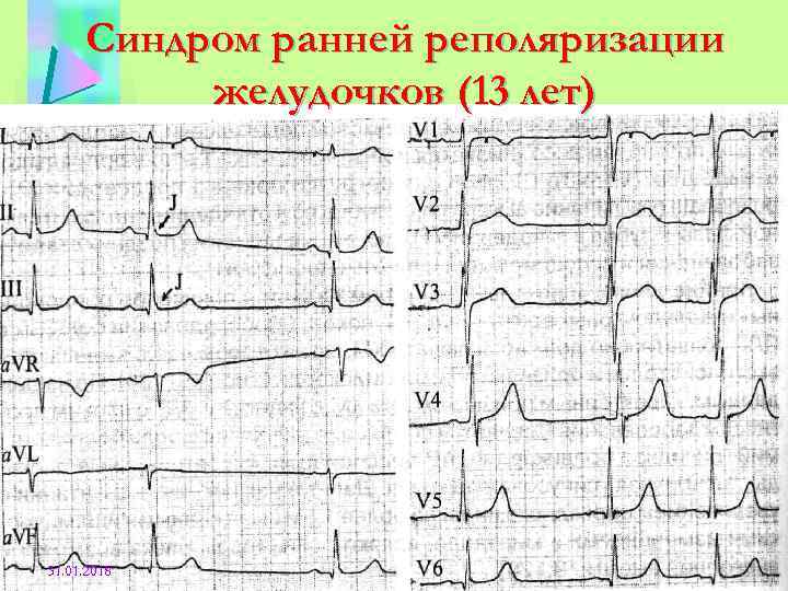 Ранний желудочков. Реполяризация желудочков на ЭКГ. Реполяризация миокарда желудочков ЭКГ. Синдром реполяризации желудочков на ЭКГ что это такое. Ранняя реполяризация желудочков сердца на ЭКГ.