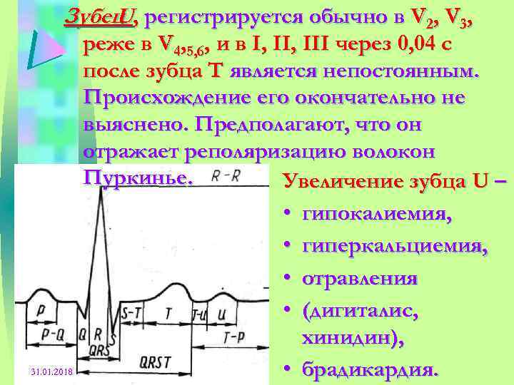 Зубец , регистрируется обычно в V 2, V 3, U 31. 01. 2018 реже