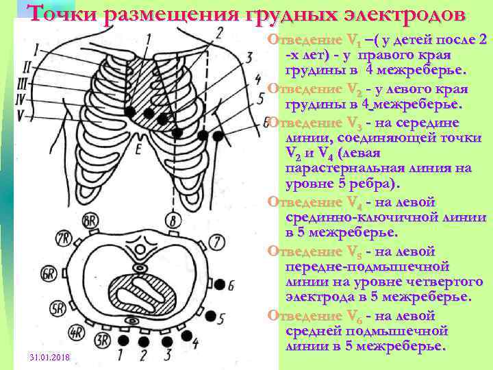 Схема наложения электродов при экг рисунок памятка