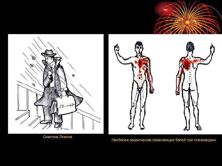 Симптом Левина Наиболее характерная локализация болей при стенокардии 