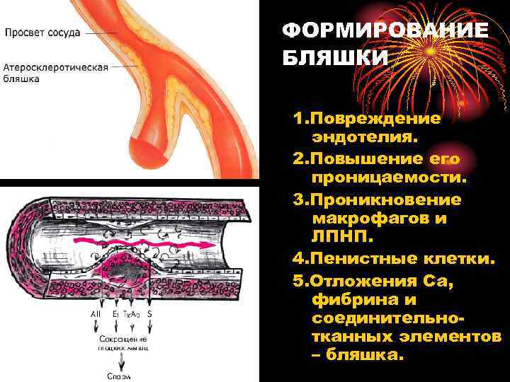 ФОРМИРОВАНИЕ БЛЯШКИ 1. Повреждение эндотелия. 2. Повышение его проницаемости. 3. Проникновение макрофагов и ЛПНП.