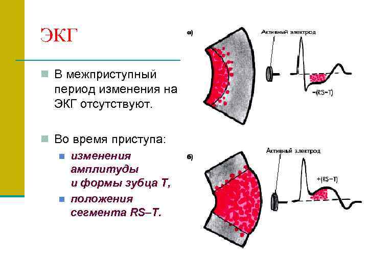 ЭКГ n В межприступный период изменения на ЭКГ отсутствуют. n Во время приступа: n