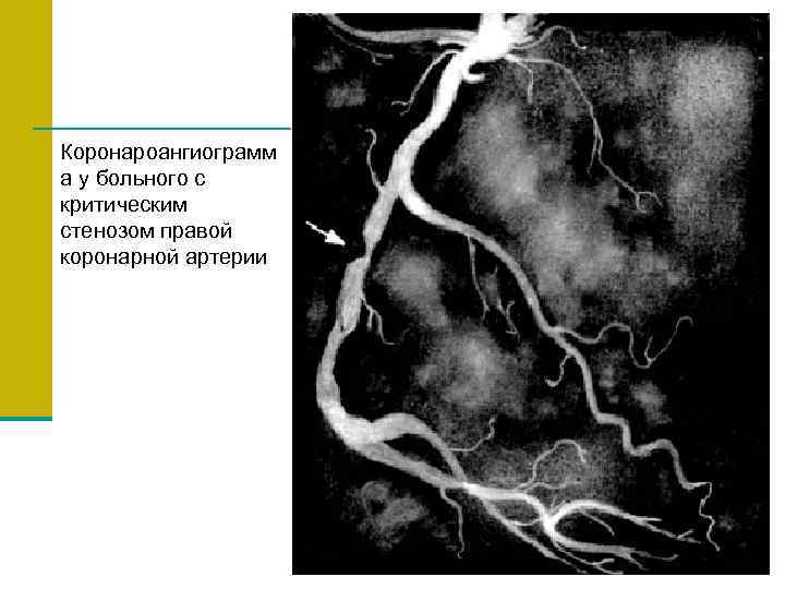 Коронароангиограмм а у больного с критическим стенозом правой коронарной артерии 