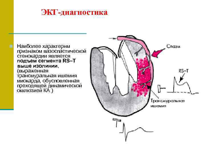 Трансмуральный инфаркт миокарда