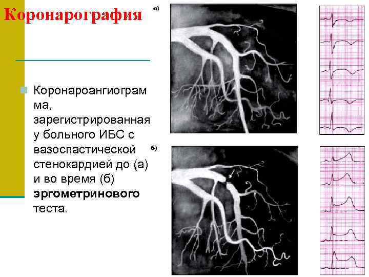 Коронарография n Коронароангиограм ма, зарегистрированная у больного ИБС с вазоспастической стенокардией до (а) и