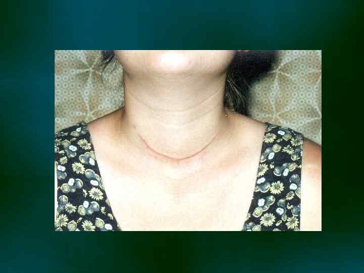 Как живете без щитовидной железы. Фолликулярная опухоль щитовидной железы 4. Фолликулярная карцинома щитовидной. Папиллярная аденома щитовидной железы. Опухоль щитовиднойсжелезы.