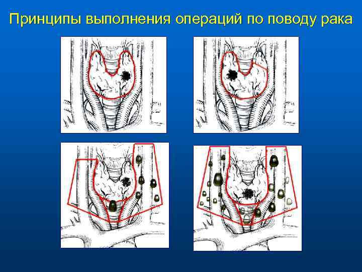 Принципы выполнения операций по поводу рака 