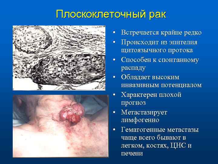 Плоскоклеточный рак • Встречается крайне редко • Происходит из эпителия щитоязычного протока • Способен
