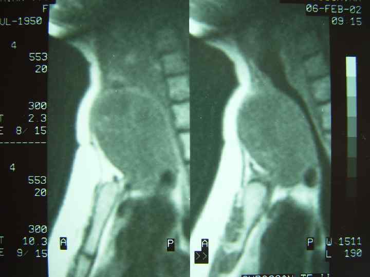 Медуллярный рак щитовидной железы на узи фото