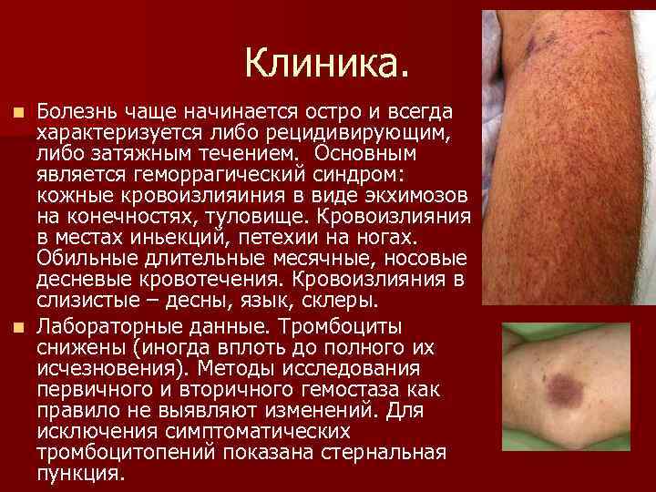Клиника. Болезнь чаще начинается остро и всегда характеризуется либо рецидивирующим, либо затяжным течением. Основным