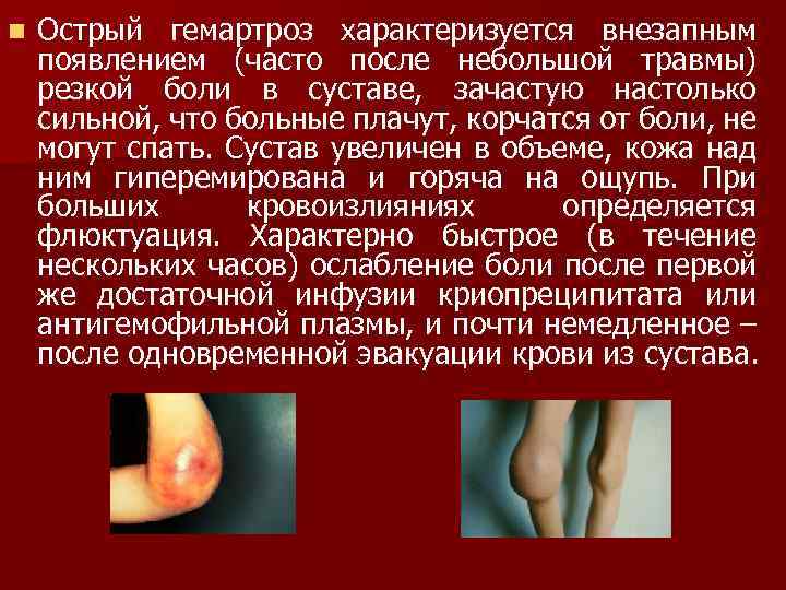 n Острый гемартроз характеризуется внезапным появлением (часто после небольшой травмы) резкой боли в суставе,