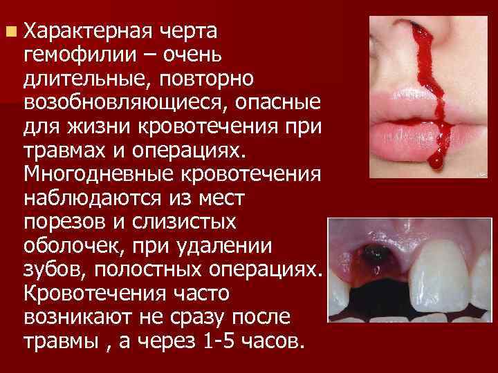 n Характерная черта гемофилии – очень длительные, повторно возобновляющиеся, опасные для жизни кровотечения при