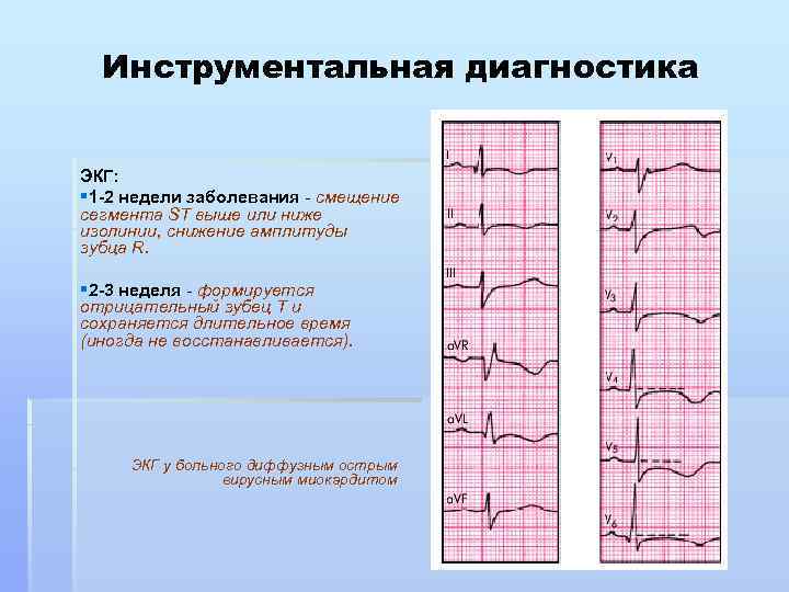 Инструментальная диагностика ЭКГ: § 1 -2 недели заболевания - смещение сегмента SТ выше или