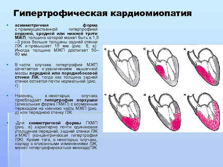 Гипертрофическая кардиомиопатия § асимметричная форма с преимущественной гипертрофией верхней, средней или нижней трети МЖП,