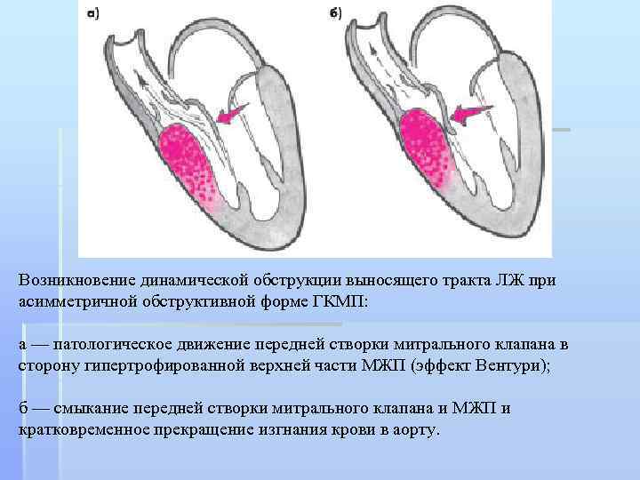 Миокарда левого желудочка. Обструкция при ГКМП. Асимметричная гипертрофия межжелудочковой перегородки. ГКМП обструктивная форма. Обструкция выходного тракта левого желудочка.