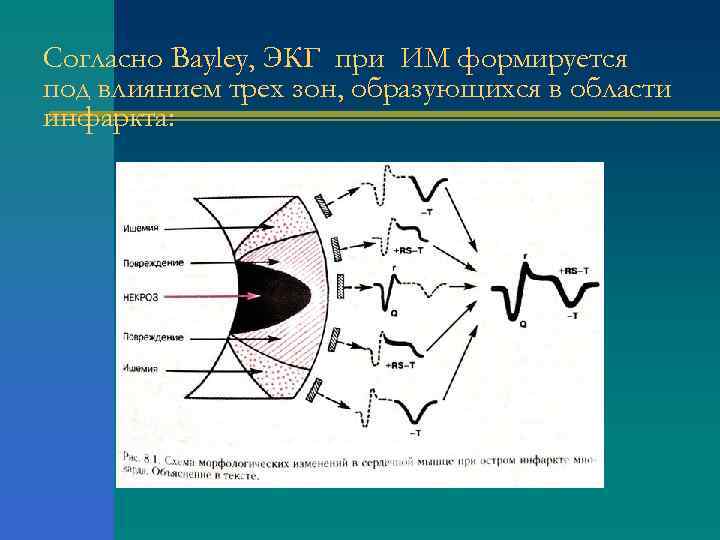 Согласно Bayley, ЭКГ при ИМ формируется под влиянием трех зон, образующихся в области инфаркта: