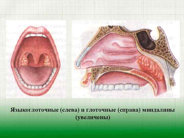 Языкоглоточные (слева) и глоточные (справа) миндалины (увеличены) 