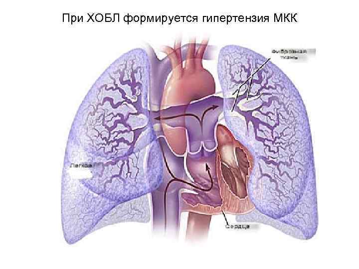 При ХОБЛ формируется гипертензия МКК 
