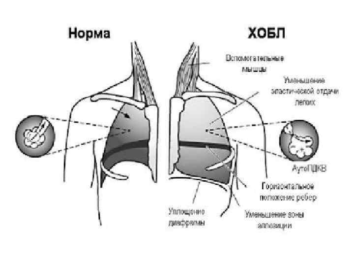 Патофизиология внешнего дыхания презентация