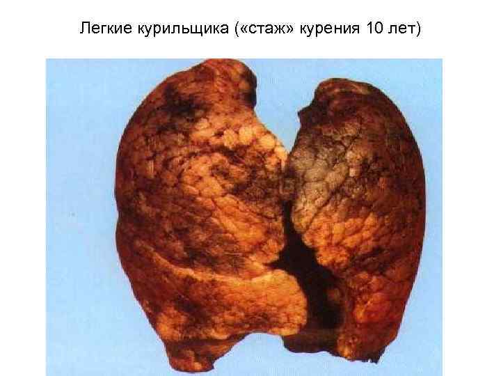 Легкие курильщика ( «стаж» курения 10 лет) 