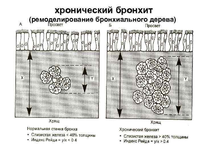 хронический бронхит (ремоделирование бронхиального дерева) 