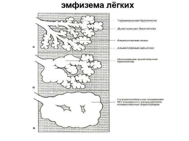 эмфизема лёгких 