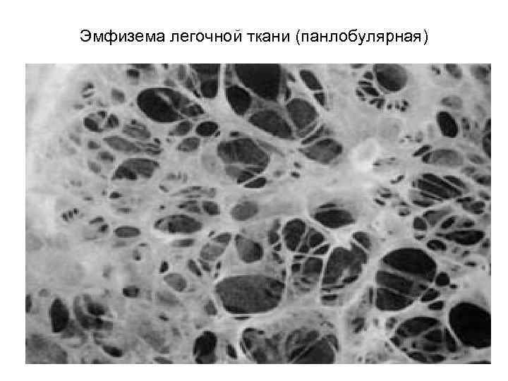 Парасептальная эмфизема на кт