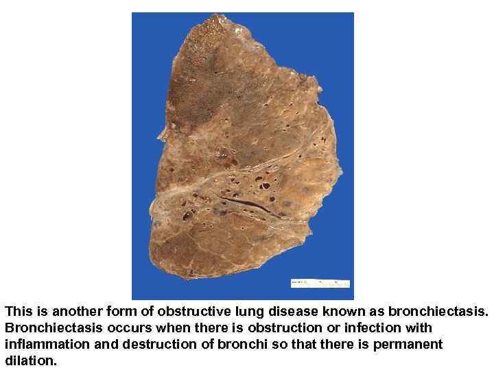 This is another form of obstructive lung disease known as bronchiectasis. Bronchiectasis occurs when